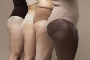 Imagem mostrando a coxa de quatro mulheres de diferentes tons de pele, com celulite visível, ilustrando os efeitos dos alimentos que aumentam a celulite em diversos tipos de pele.