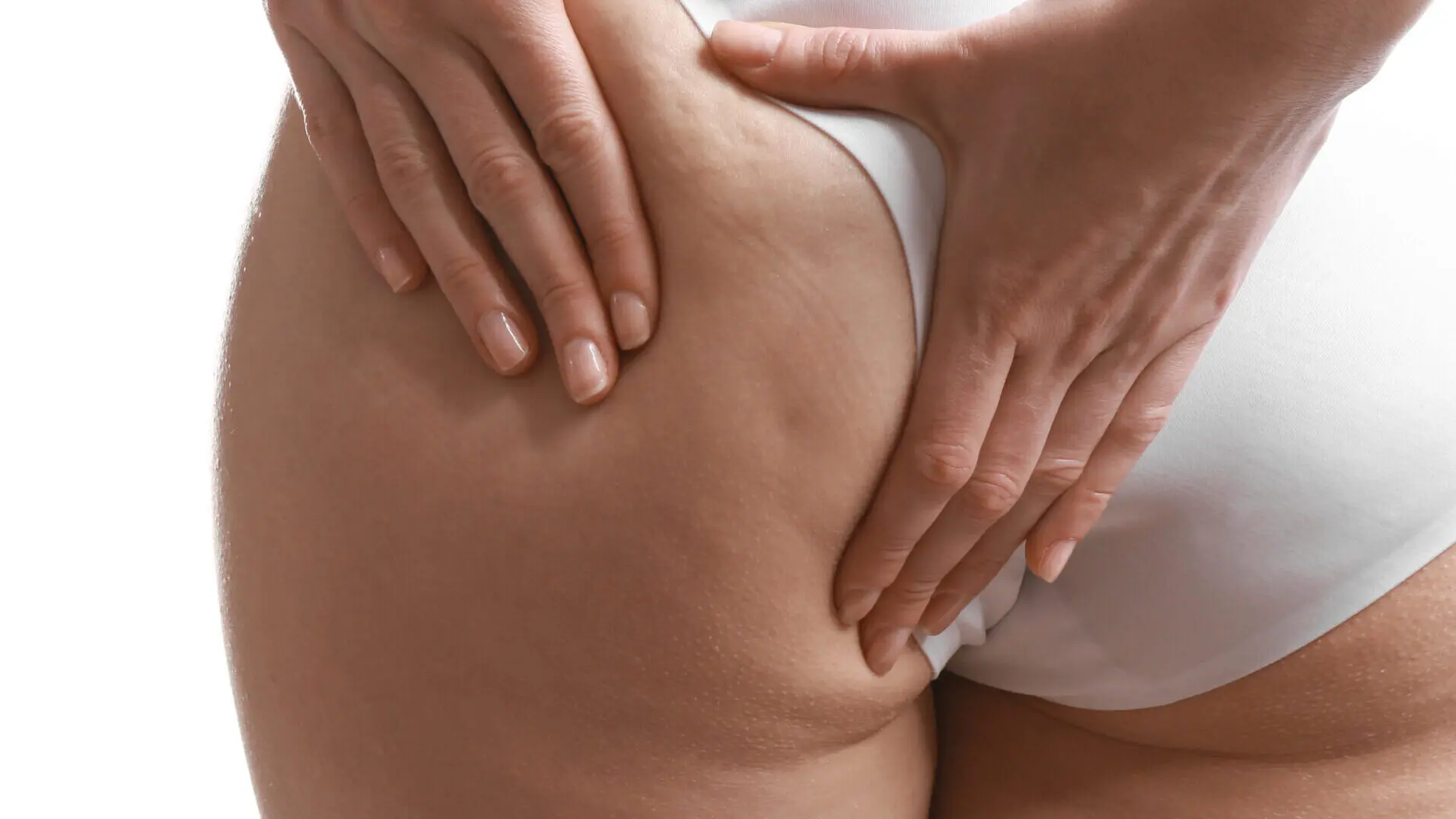 Tratamento estético celulite: imagem em plano fechado de uma mulher pressionando a pele do bumbum com as mãos, evidenciando os sinais de celulite. Ilustração comum usada em conteúdos sobre tratamento para celulite.