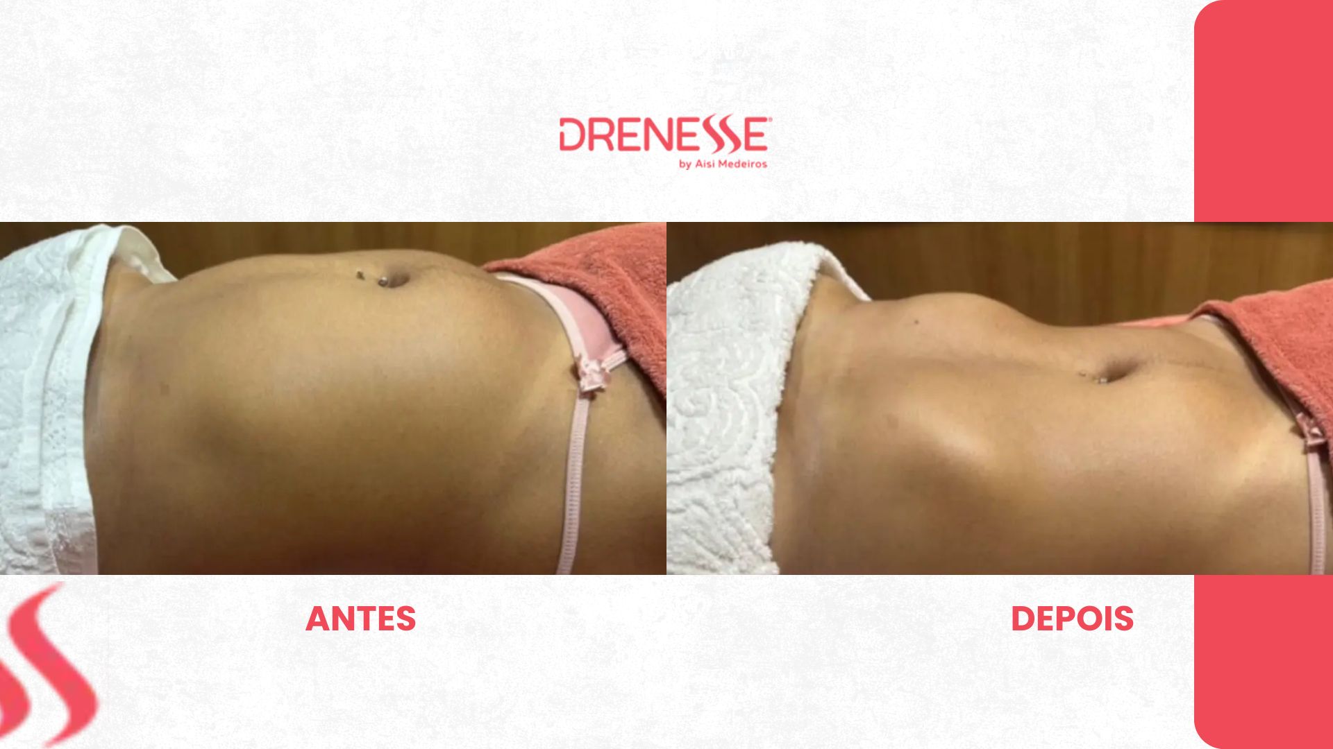 método drenesse