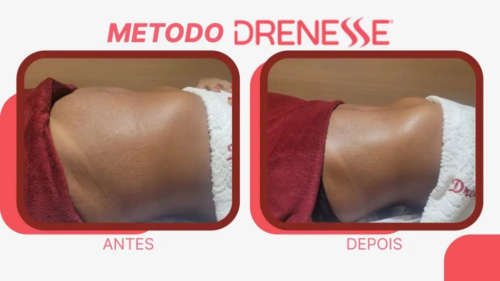 ANTES E DEPOIS DE UMA BARRIGA QUE PASSOU PELO METODO DRENESSE APÓS ACORDAR INCHADA