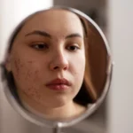 menina jovem com acne no rosto